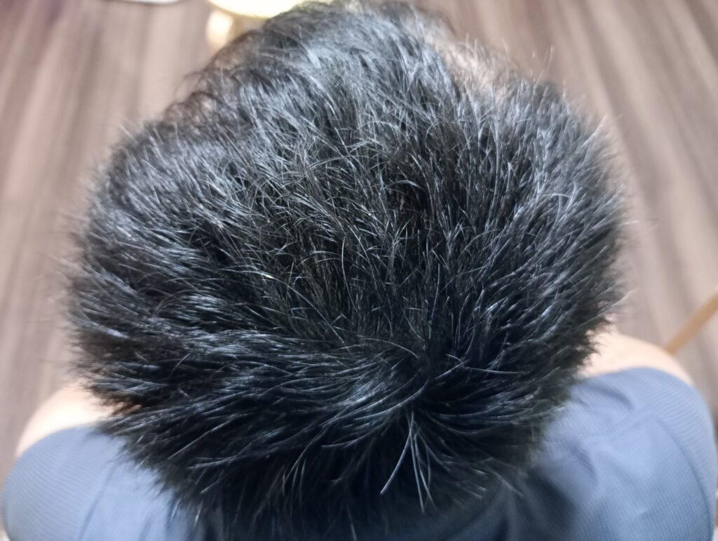 AGA治療開始55日後
