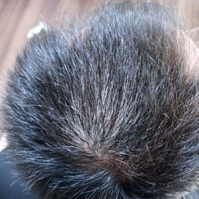 頭頂部ハゲ
